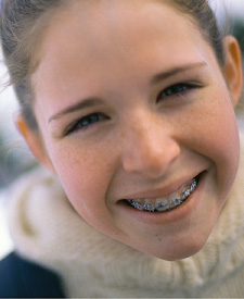 Why Braces?